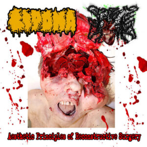 LIPOMA/SEIZURE STOMP - Aesthetic Principles Of Reconstructive Surgery - Split