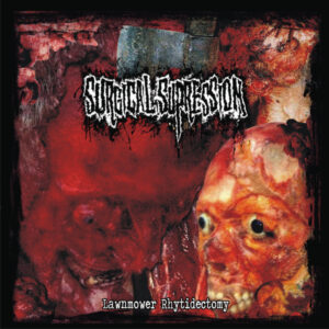 SURGICAL SUPRESSION - Lawnmower Rhytidectomy